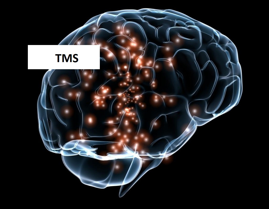 TMS - Transcranial Magnetic Stimulation